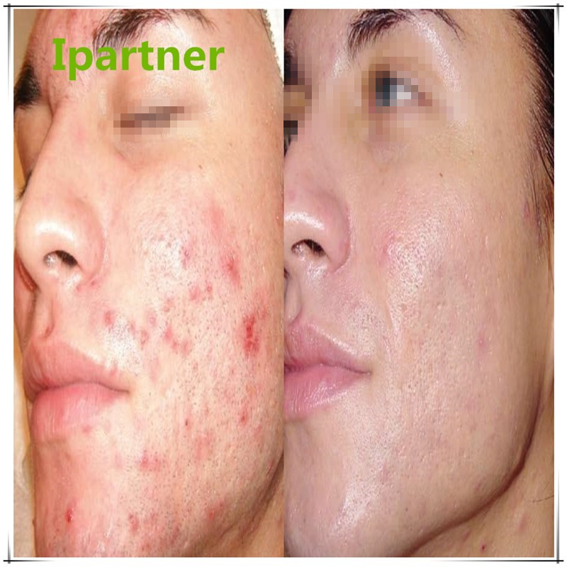 Venta caliente Derma Roller para el cuidado de la piel.