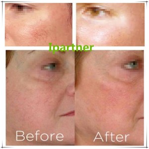 El láser de diodo Ipartner LS980 alivia el sistema de enrojecimiento