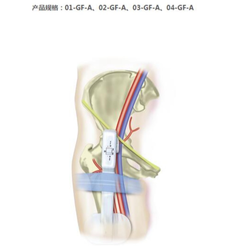 Goldfinger Electronic arteria femoral detentor de hemorragia