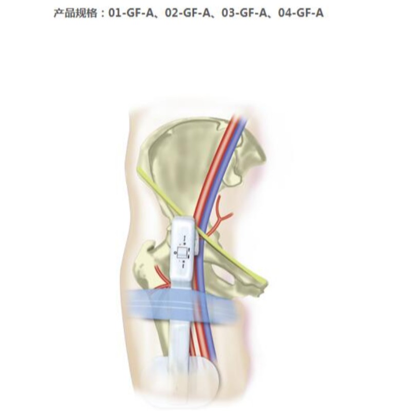 Goldfinger Electronic arteria femoral detentor de hemorragia